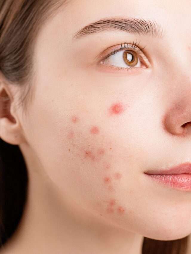 10 ways to prevent acne on the skin, must know