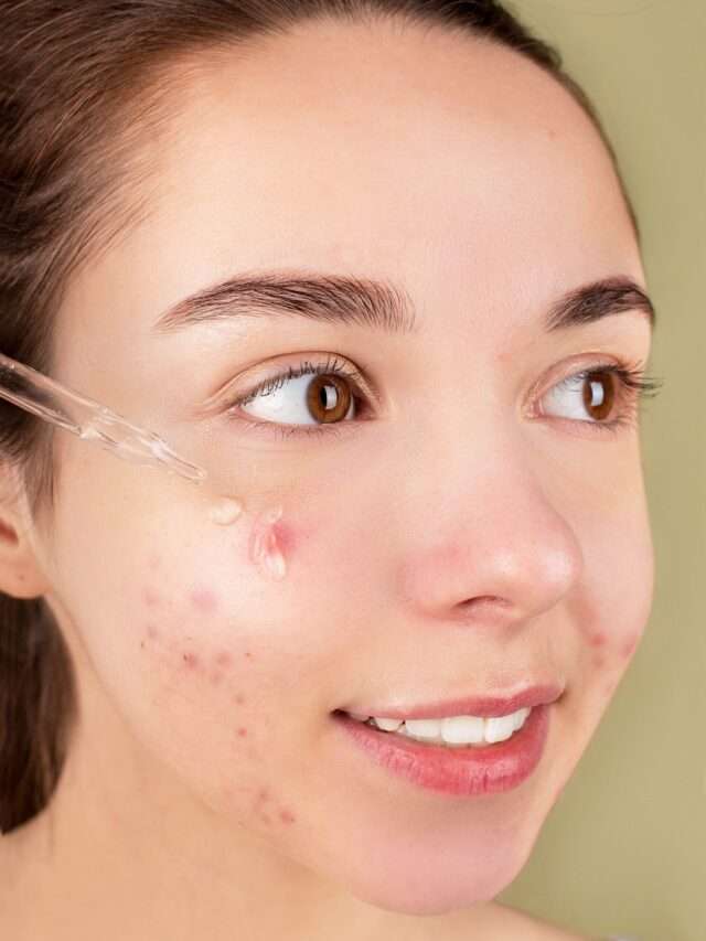 10 ways to prevent acne on the skin, must know