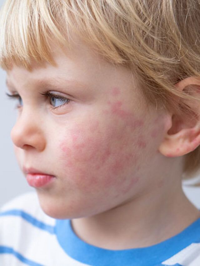 'Deadly' chocolate can cause serious allergic reactions.