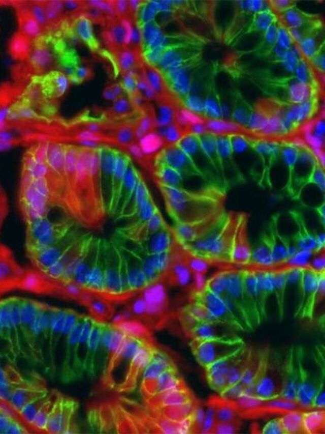 Unveiling the Threat Colon Cancer Impact in Colorado's Youth